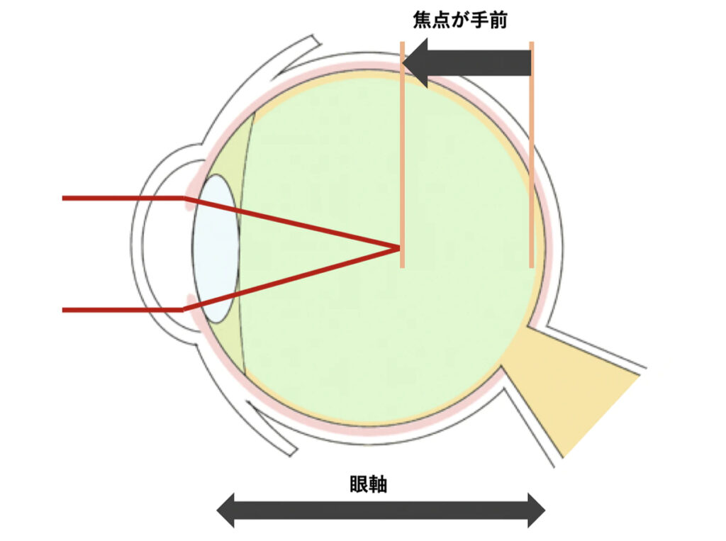 日本公司推出可以治疗近视的智慧眼镜