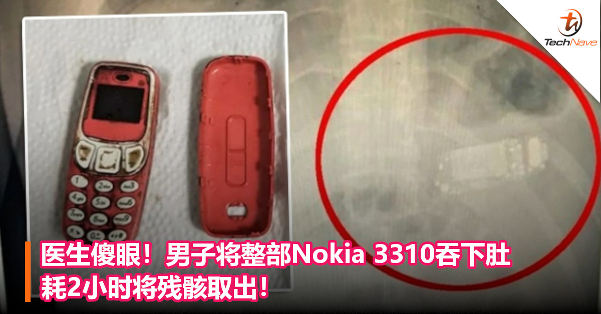 医生傻眼！男子将整部Nokia 3310吞下肚，耗2小时将残骸取出！