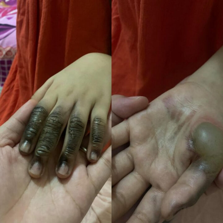 菲律宾7岁女童手指因插座爆炸而灼伤!