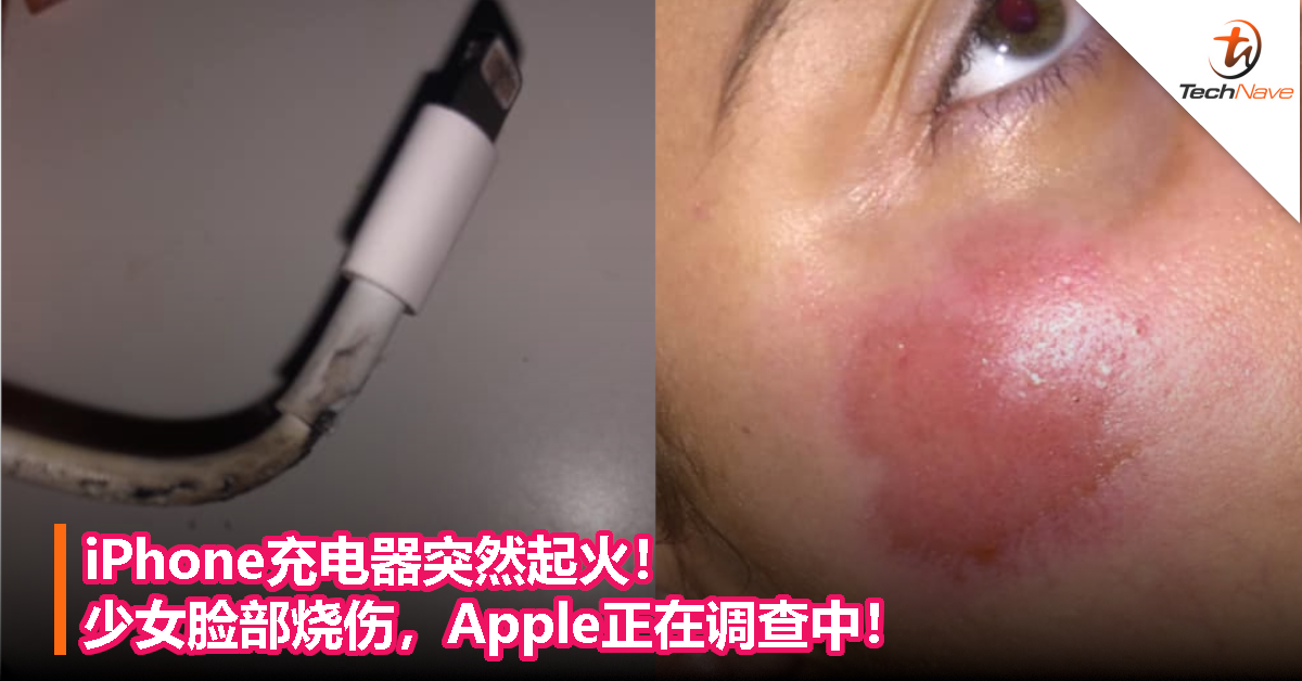 iPhone充电器突然起火！少女脸部烧伤，Apple正在调查中！