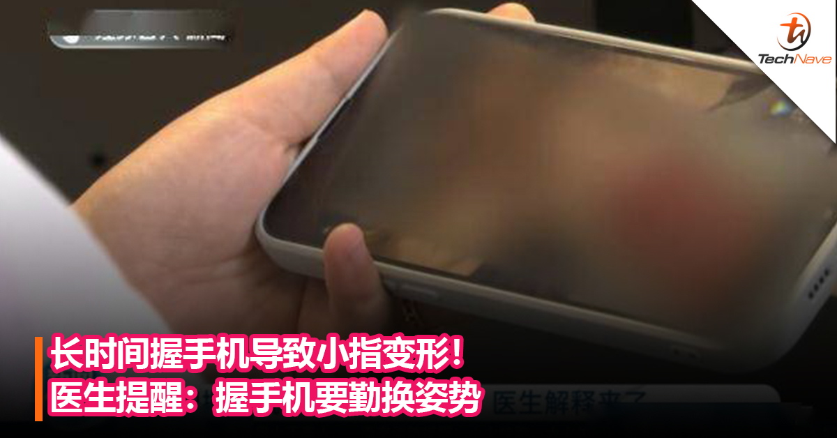 长时间握手机导致小指变形！医生提醒：握手机要勤换姿势