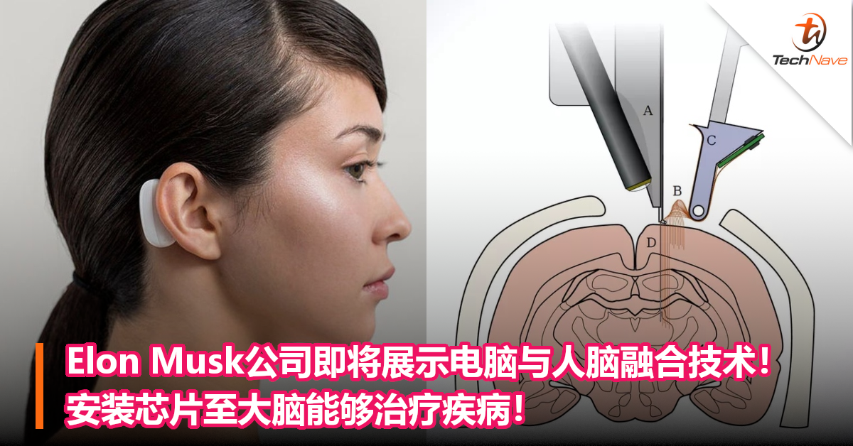 外媒：Elon Musk公司开启电脑与人脑融合技术的人体试验！安装芯片至大脑治疗疾病！